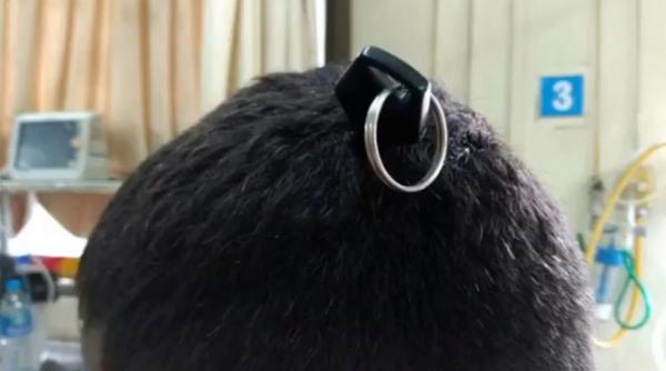 medicii i au scos din cap o cheie de motocicleta