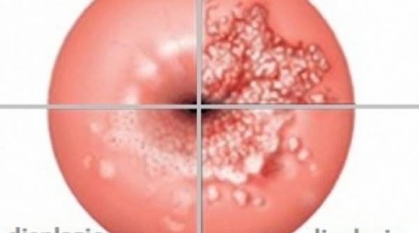 daca faci corect si la timp acest test poti preveni cancerul de col uterin