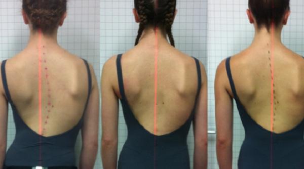 bolile coloanei vertebrale la copii ce e de facut pentru a le preveni si trata