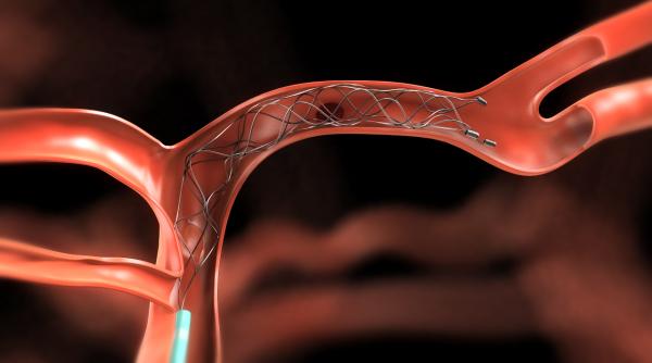 interventie endovasculara in premiera la timisoara cum a fost salvat de medici un tanar de 19 ani