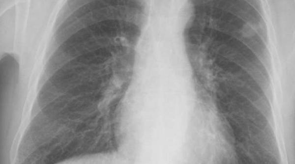 in fiecare ora un roman este diagnosticat cu o forma de cancer pulmonar ce trebuie sa stii despre diagnosticul precoce si tratament