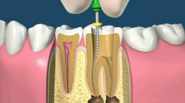 miturile romanilor la dentist un medic specialist in endodontie le explica si le demonteaza