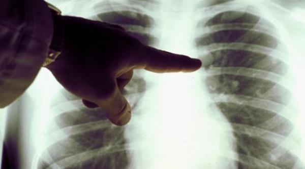 fibroza chistica ar putea fi tratata gratie unor celule nou descoperite