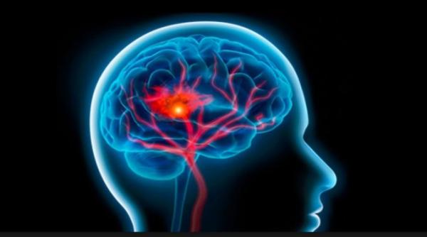 la fiecare cinci secunde un om moare de accident vascular cerebral ce spun medicii romani
