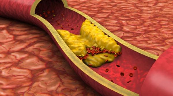 arteriopatia periferica ce este si cum se trateaza