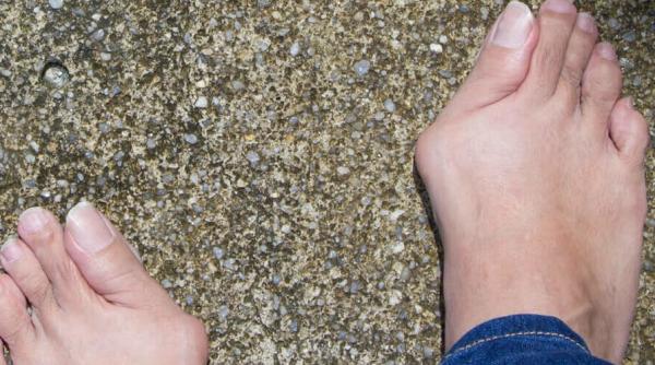 monturile cum le tratam sfatul medicului specialist video