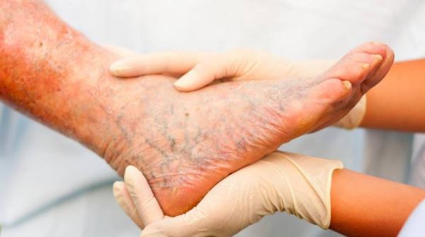 piciorul diabetic si tratamentul lui ce sa faci ca sa elimini riscurile amputarii