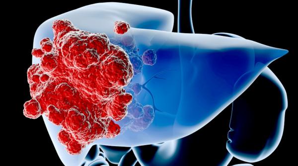 afectiunile hepatice de la diagnosticare la stadiul final