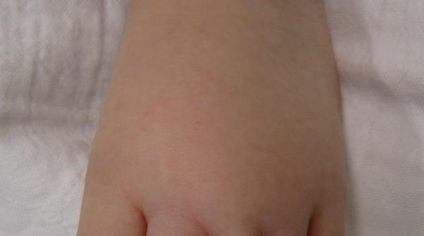 sindromul parului rasucit un copil era pe punctul de a si pierde patru degete