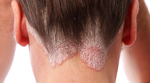 psoriazisul tot ce trebuie sa stii despre aceasta boala