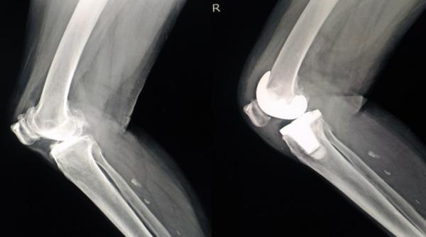 sfatul medicului protezarea articulara sau artroplastia ce trebuie sa stii