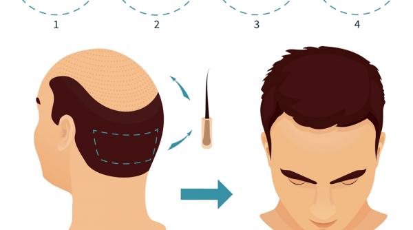 transplant de par prin metoda fue intrebari si raspunsuri da