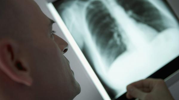 concediu pana la vindecare pentru bolnavii de tbc