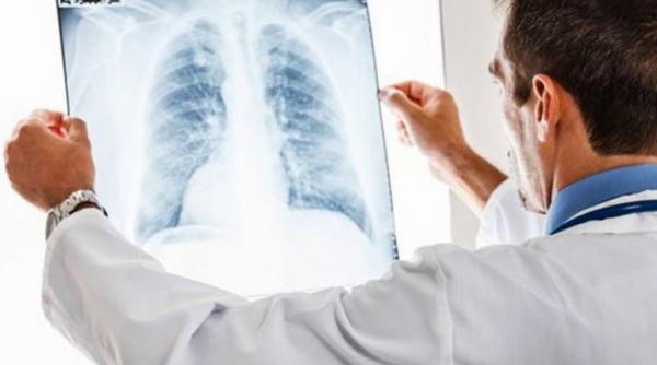 alarmant peste 10 000 de cazuri noi de cancer pulmonar depistate anual in romania