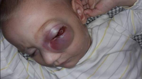 diagnosticat cu cancer o forma rara la doar un an si 10 luni