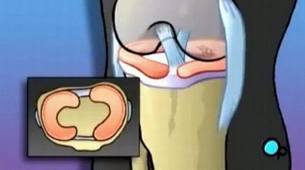 leziunea de menisc cum o tratam video