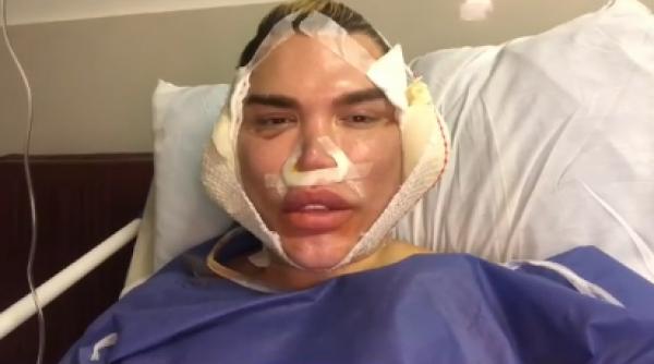 papusa ken si a facut a 62 a operatie estetica