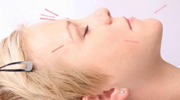 sfatul medicului totul despre lifting facial acupunctura fitoterapie azi