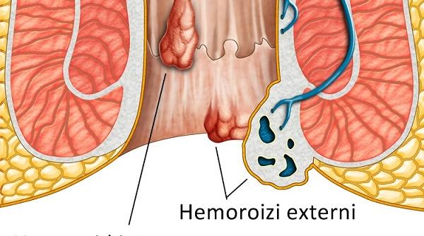 tot ce trebuie sa stii hemoroizi diagnotic cauza tratament azi