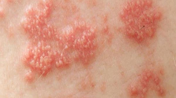 tratamente naturiste 6 remedii naturale impotriva zonei zoster