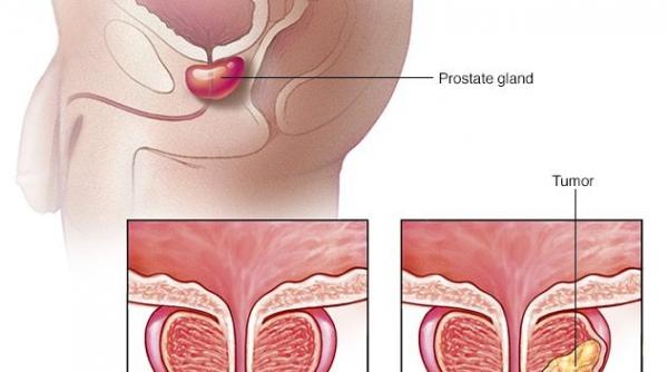 cancerul de prostata diagnostic si tratament