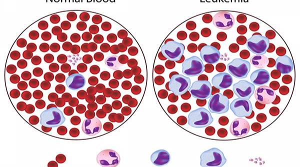 sfatul medicului tot ce trebuie sa stii despre leucemie cauze diagnostic tratament