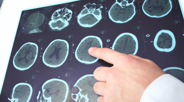 130 000 de romani sufera de epilepsie