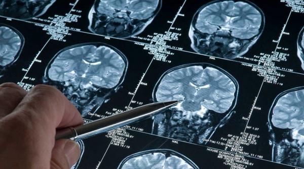 alarmant 60 000 de romani cu traumatisme craniene in fiecare an