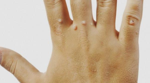 negii sau verucile diagnostic si tratament 2