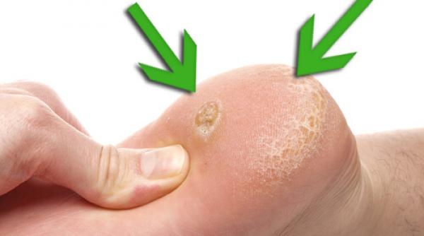 tratamente naturiste cum elimini definitiv bataturile mod natural 1