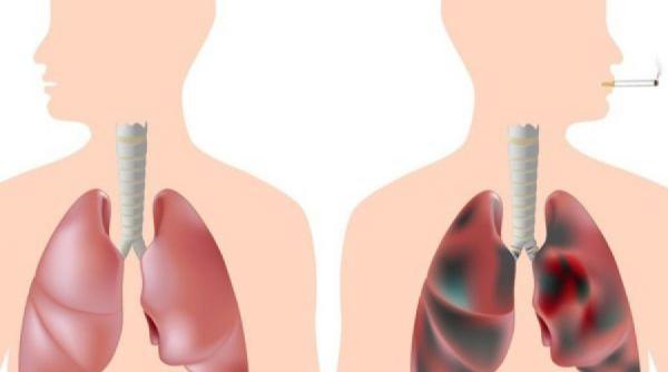 elixirul fumatori remediu natural curatarea plamanilor 1