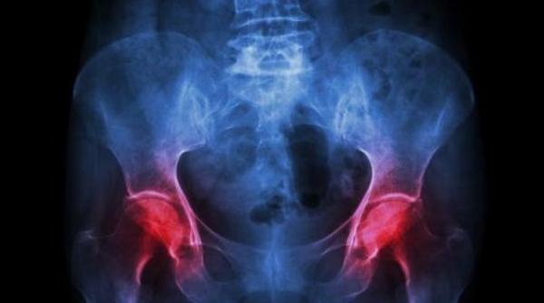 de ce mor batranii dupa o fractura de sold diagnostic riscuri tratament 1