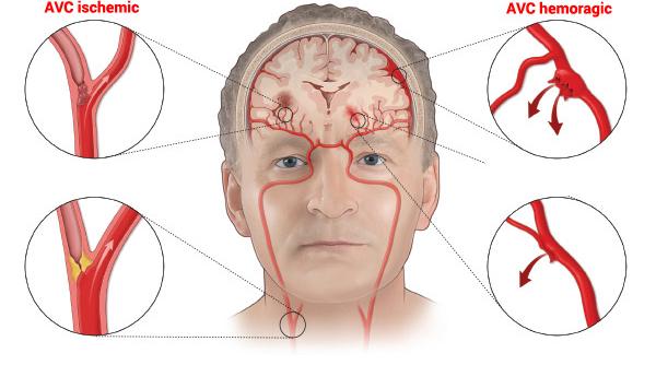 accident vascular cerebral avc simptome tratament si recuperare