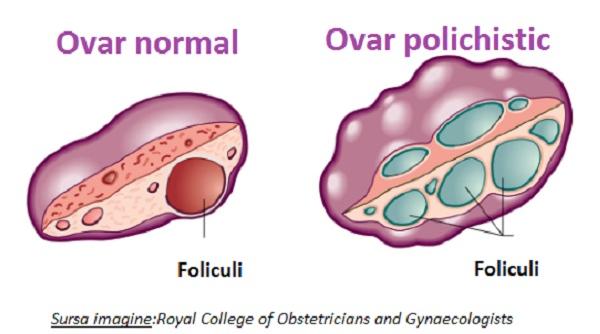 sfatul medicului tot ce trebuie sa stii despre sindromul ovarului polichistic cauze diagnostic tratament 1