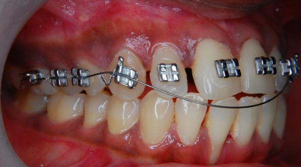 aparatul dentar la copii necesitate sau moda