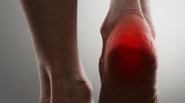 te doare calcaiul ai fasceita plantara ce este de fapt si cum o tratezi 1