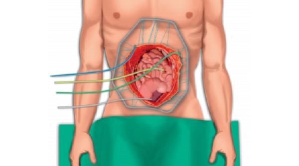 cancerul peritoneal simptome si speranta de viata 1