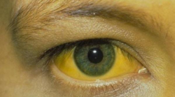 bilirubina in sange cum influenteaza sanatatea ficatului 2