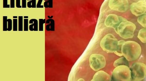12 reguli de aur pentru prevenirea sau dizolvarea pietrelor biliare