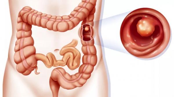 detoxifierea colonului repede si natural 13 alimente care te ajuta