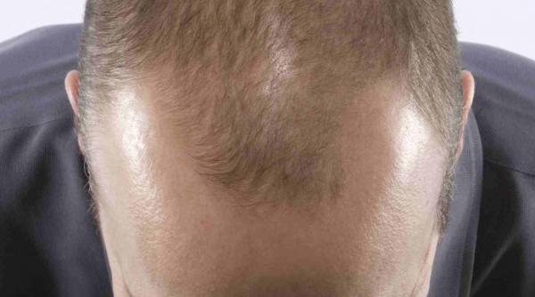 va cade parul iata ce leacuri recomanda farm dr ovidiu bojor 1