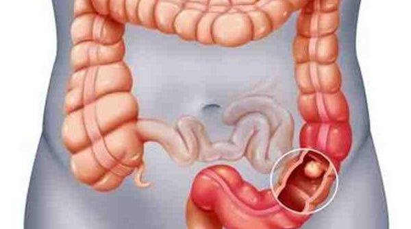 rezectiile colo rectale laparoscopice in cancerul de colon sau rect