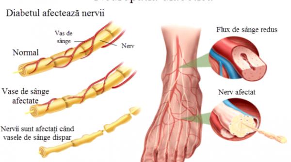 neuropatia diabetica diabetul zaharat pericol major pentru sanatatea picioarelor 1