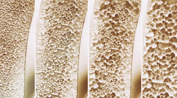 anotimpul rece factor de risc pentru osteoporoza