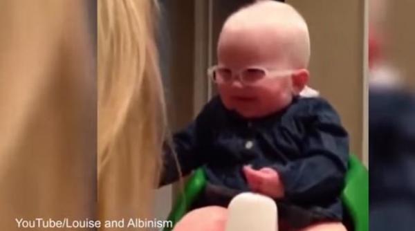 tot ce trebuie sa stii despre albinism