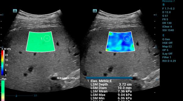 ecografia tesuturilor moi cand si de ce