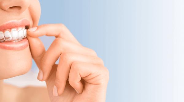 tot ce trebuie sa stii despre tratamentul de indreptare a dintilor cu ajutorul aparatului dentar invizibil invisalign