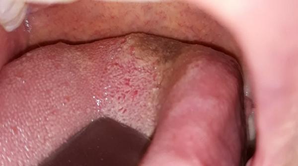 limba cu solzi un simptom necunoscut al covid