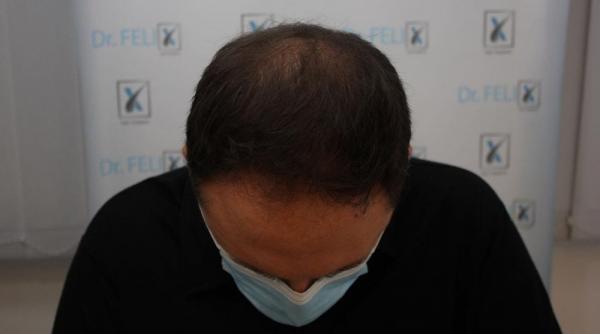 chelie timpurie transplantul de par in clinica dr felix hair implant poate fi solutie