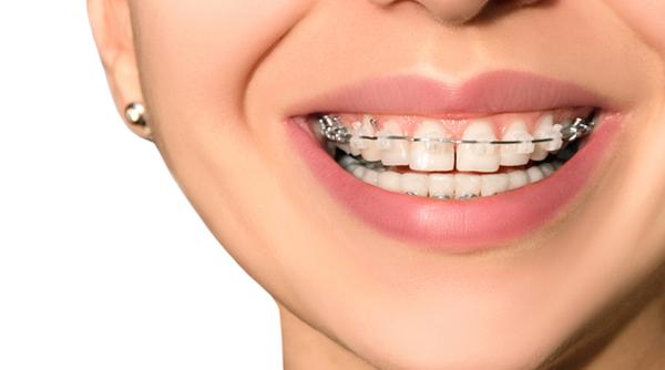 5 motive pentru care ar trebui sa iti pui aparat dentar